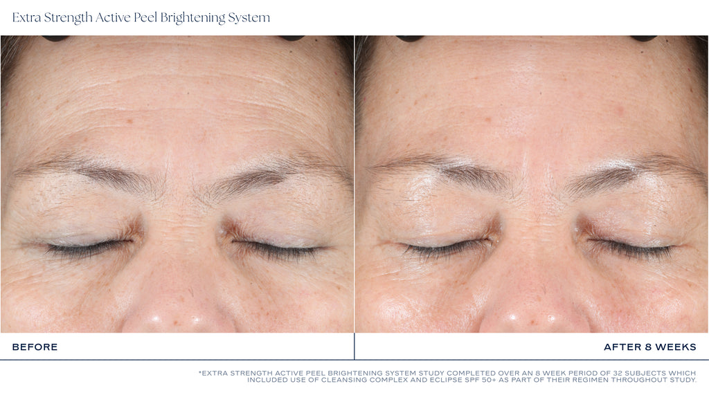 Extra Strength Active Peel Brightening System